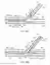 Fig. 34 - Stent alignment during treatment of a bifurcation