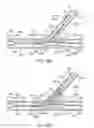 Fig. 35 - Stent alignment during treatment of a bifurcation