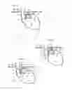 Fig. 02 - Methods and instruments for treating GERD and haital hernia