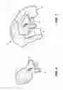 Fig. 07 - Systems, Methods, and Devices for Improving Airflow-Related Sleep Problems