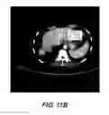 Fig. 13 - METHODS FOR TREATING CANCER