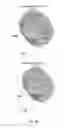 Fig. 30 - Methods for treating cancer with RORγ inhibitors