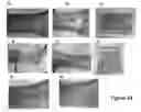 Fig. 11 - MULTIFUNCTIONAL COMPOSITE SKIN OR WOUND DRESSING AS REGENERATIVE SKIN SUBSTITUTE
