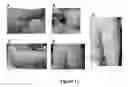Fig. 12 - MULTIFUNCTIONAL COMPOSITE SKIN OR WOUND DRESSING AS REGENERATIVE SKIN SUBSTITUTE
