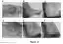 Fig. 14 - MULTIFUNCTIONAL COMPOSITE SKIN OR WOUND DRESSING AS REGENERATIVE SKIN SUBSTITUTE