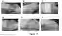 Fig. 16 - MULTIFUNCTIONAL COMPOSITE SKIN OR WOUND DRESSING AS REGENERATIVE SKIN SUBSTITUTE