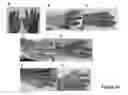 Fig. 25 - MULTIFUNCTIONAL COMPOSITE SKIN OR WOUND DRESSING AS REGENERATIVE SKIN SUBSTITUTE