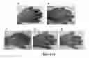 Fig. 26 - MULTIFUNCTIONAL COMPOSITE SKIN OR WOUND DRESSING AS REGENERATIVE SKIN SUBSTITUTE