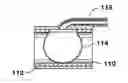 Fig. 01 - Arteriovenous access valve system and process
