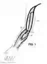 Fig. 02 - Arteriovenous access valve system and process