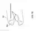 Fig. 37 - Medication administering device