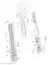 Fig. 09 - Coaxial venal cannula