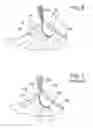 Fig. 05 - Offset catheter securement device with removable retention member