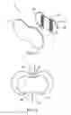 Fig. 07 - Offset catheter securement device with removable retention member