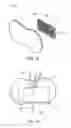 Fig. 08 - Offset catheter securement device with removable retention member
