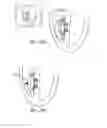 Fig. 16 - Device and method for positioning an electrode in tissue
