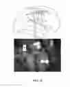 Fig. 13 - SKULL IMPLANTED ELECTRODE ASSEMBLY FOR BRAIN STIMULATION