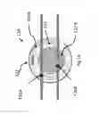 Fig. 17 - Apparatus and method for treating multiple tumors in patients with metastatic disease by electric fields
