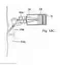Fig. 16 - Method for controlling flow in a bodily organ