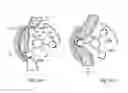 Fig. 33 - Method for controlling flow in a bodily organ