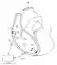 Fig. 01 - Atrial tracking in an intracardiac ventricular pacemaker