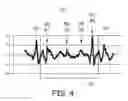 Fig. 05 - Atrial tracking in an intracardiac ventricular pacemaker