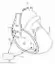 Fig. 01 - Atrial tracking in an intracardiac ventricular pacemaker