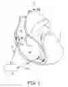 Fig. 02 - Atrial tracking in an intracardiac ventricular pacemaker