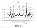 Fig. 05 - Atrial tracking in an intracardiac ventricular pacemaker