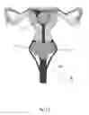 Fig. 12 - Brachytherapy Applicator