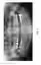 Fig. 02 - Therapeutic tooth bud ablation