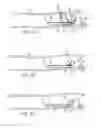 Fig. 04 - Apparatus and methods for removing obstructive material from body lumens