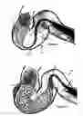 Fig. 02 - Methods for delivering and using a stent