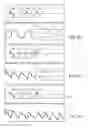 Fig. 28 - Maintaining active compression decompression device adherence