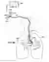 Fig. 16 - Medical tubes for selective mechanical ventilation of the lungs