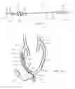 Fig. 14 - Apparatus and methods for treating obstructions within body lumens