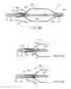 Fig. 34 - Apparatus and methods for treating obstructions within body lumens