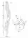 Fig. 02 - Device and method for percutaneous placement and anchoring of stimulating electrodes in spine