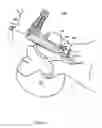 Fig. 04 - Illuminated laryngoscope