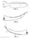 Fig. 03 - Guiding device for use with laryngoscope