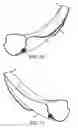Fig. 06 - Guiding device for use with laryngoscope