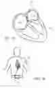 Fig. 02 - Deploying and fixating an implant across an organ wall