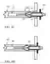 Fig. 07 - Deploying and fixating an implant across an organ wall