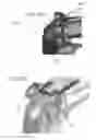 Fig. 27 - Circular bone tunneling device employing a stabilizing element