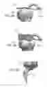 Fig. 33 - Circular bone tunneling device employing a stabilizing element