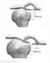 Fig. 34 - Circular bone tunneling device employing a stabilizing element