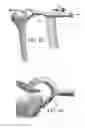 Fig. 35 - Circular bone tunneling device employing a stabilizing element