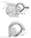 Fig. 36 - Circular bone tunneling device employing a stabilizing element