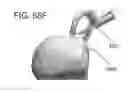 Fig. 53 - Circular bone tunneling device employing a stabilizing element