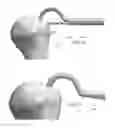 Fig. 59 - Circular bone tunneling device employing a stabilizing element